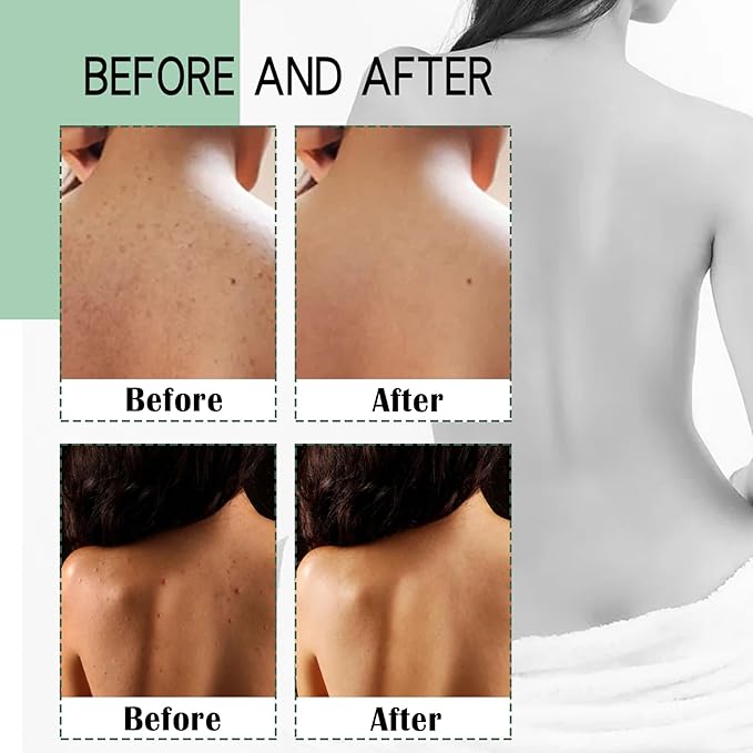 Back Acne Treatment Spray, Body Acne