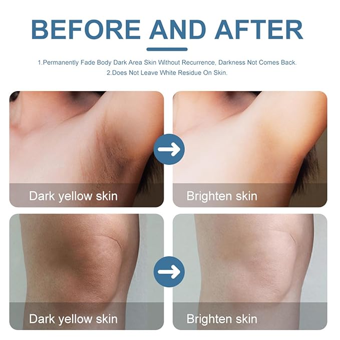 Skin Bleaching Cream For Body Dark