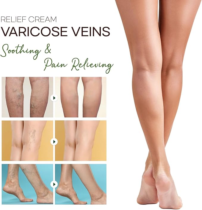 Varicose Veins Cream - Varicose Veins