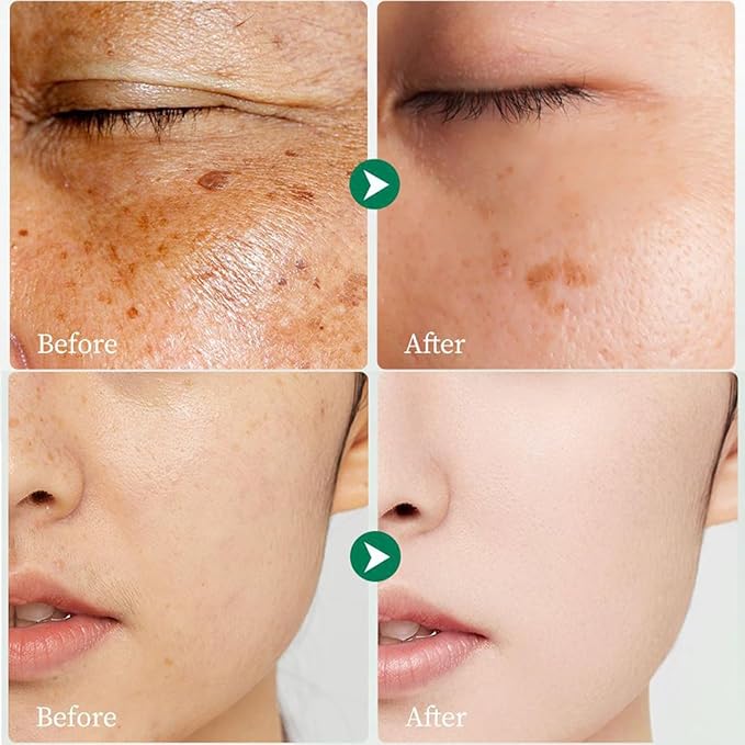 Dark Spot Remover for Face and