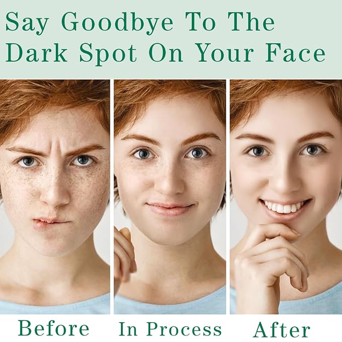 Dark Spot Remover for Face and