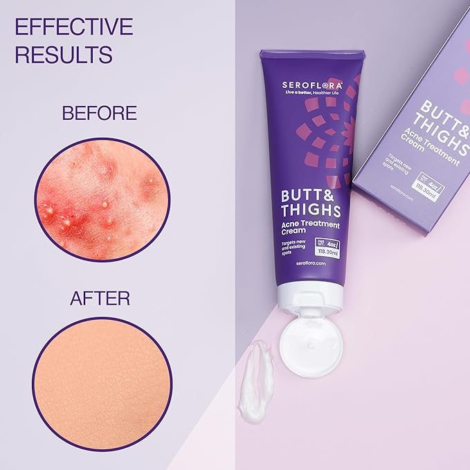 Butt & Thighs Acne Treatment Cream