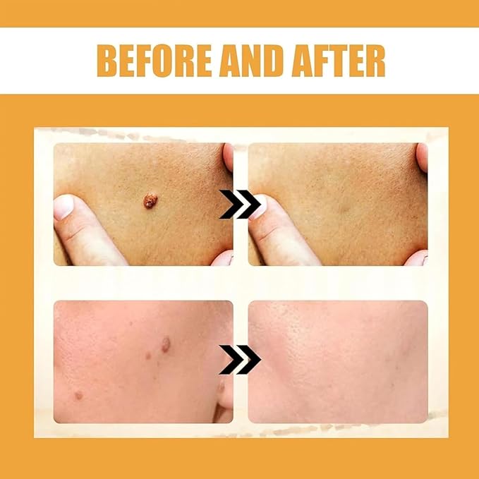 Bee Venom Cream for Removing and