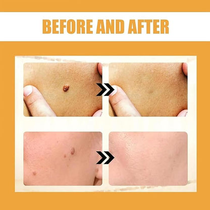 Bee Venom Cream for Removing and