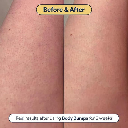 Remedy for Body Bumps – Treatment for Keratosis Pilaris (KP) and Textured, Crepey Skin with Urea, Lactic Acid, and Retinol -– Smoothing Body Moisturizer Lotion – By Dermatologist Dr. Shah