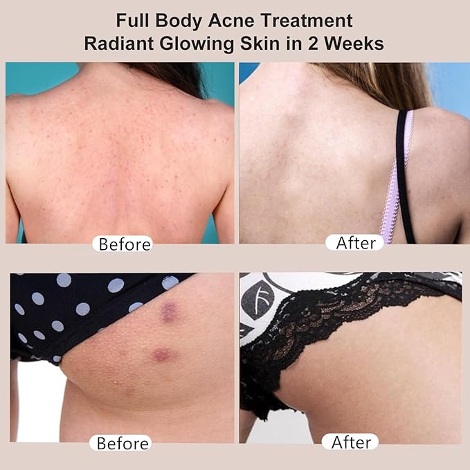 Butt Acne Clearing Treatment, Moisturizer Cream