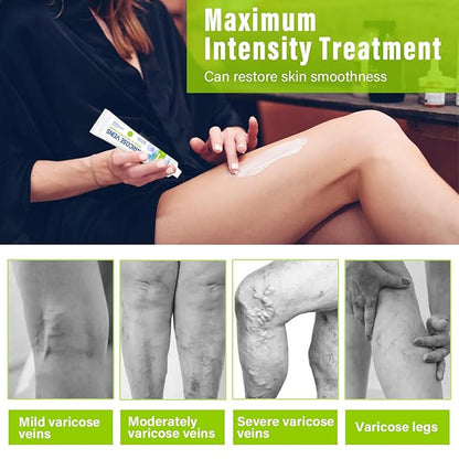 MOSKILA Varicose Veins Treatment for Legs,