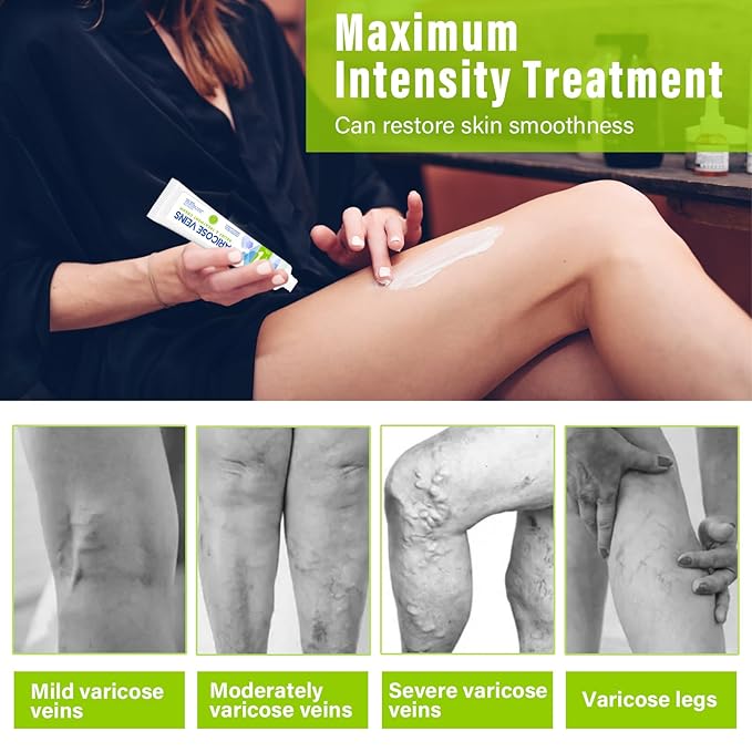 MOSKILA Varicose Veins Treatment for Legs,