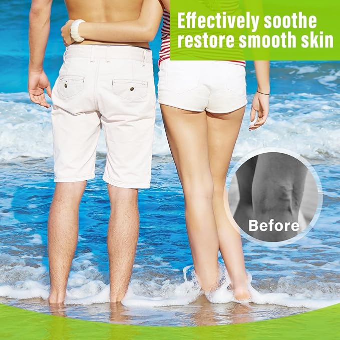 MOSKILA Varicose Veins Treatment for Legs,