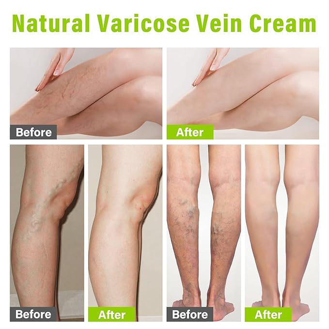 MOSKILA Varicose Veins Treatment for Legs,
