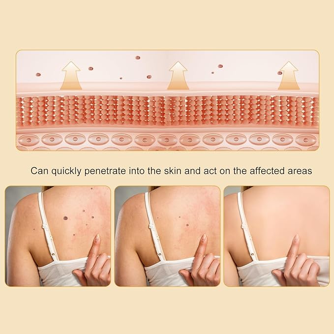 Bee Venom Cream for Removing and