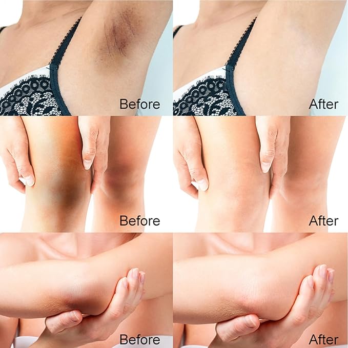 Skin Bleaching Cream For Body Dark