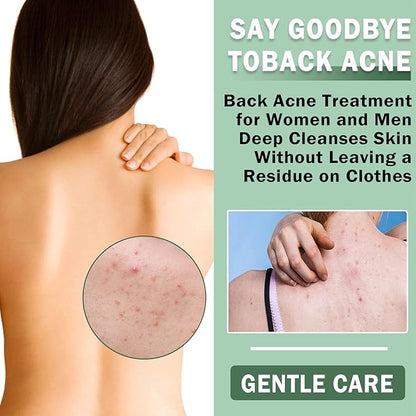 Back Acne Treatment Spray, Body Acne