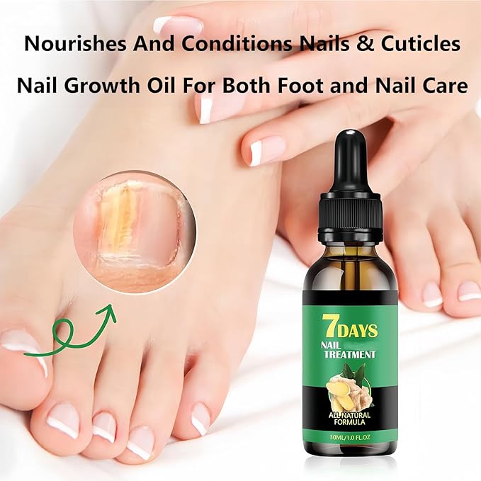 Ginger Nail Treatment-Nail Strengthener for Damaged Nails-Mild Nail Growth Serum for Gingernail & Toenail-Easy to Use, 1Pc 30ML