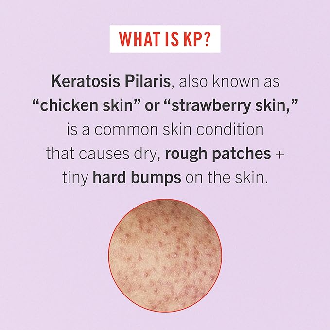 First Aid Beauty Bye Bye Bumps